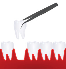 Tooth implant model. vector illustration