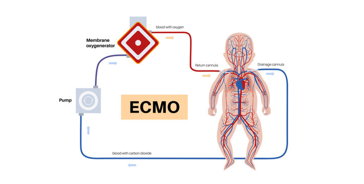 Extracorporeal membrane oxygenation