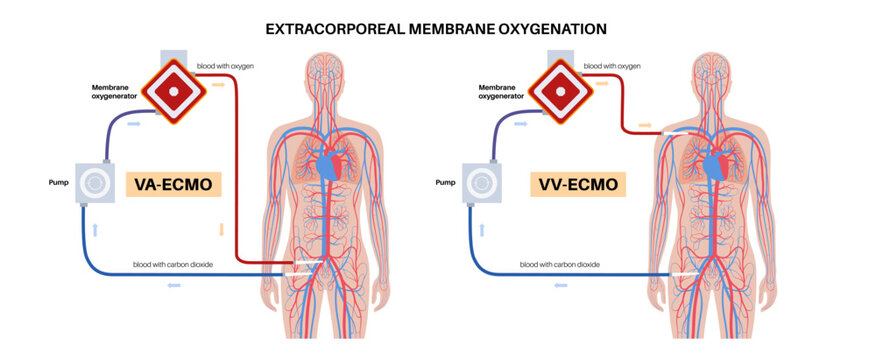 Extracorporeal membrane oxygenation