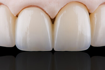 Close up photo frontal dental bridge of upper teeth made of zirconium for fixation to upper jaw.
