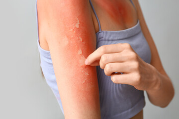 Young woman removing red sunburned skin on grey background, closeup
