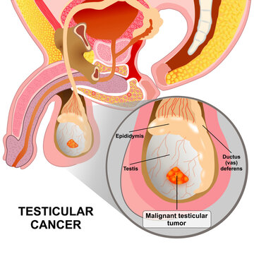Malignant testicular cancer medical illustration