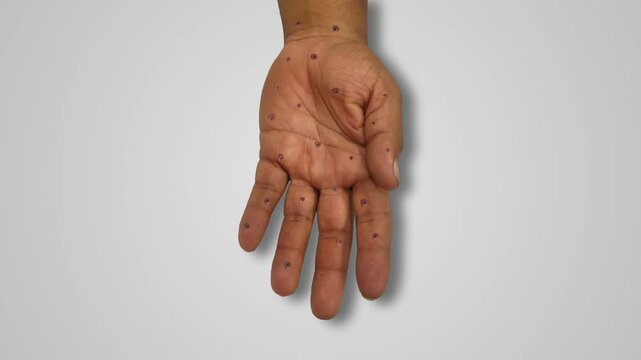 Viral monkeypox lesion syndrome acquired by hand