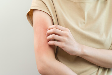 young woman scratching on her arm and has a red rash irritation on her skin from dust intolerance.