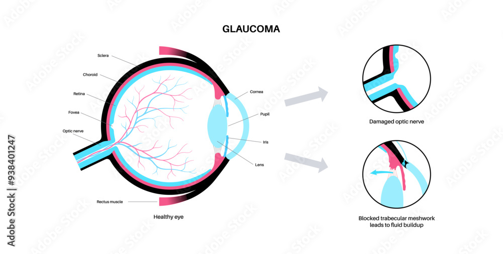 Wall mural glaucoma eye disease