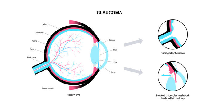 Glaucoma eye disease