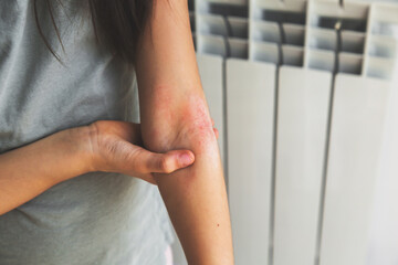 a girl shows her combed dry skin on the bend of her elbow, redness, roughness, itching from atopic...