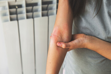 a girl shows her combed dry skin on the bend of her elbow, redness, roughness, itching from atopic...