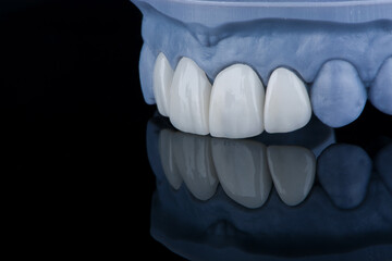 Dental single crowns made of zirconium in bleach color for fixation to frontal teeth of upper jaw.