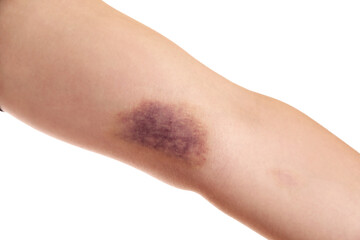 Woman with bruise on arm against white background, closeup