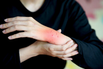 Person with a swollen, irritated wrist, possibly inflamed or injured, wearing black long sleeves...