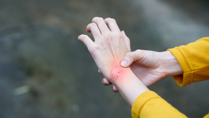 A person wearing a yellow sleeve holding an irritated and red wrist, indicating pain or skin condition on a blurred background.