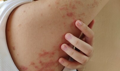 close up of a patient scratching the rash hives allergy and inflammation skin, reaction and urticaria, scar and dark spots, inflammation skin on the body, health care and medical concept.