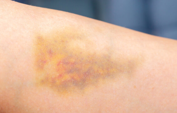 Bruises on the human body. Severe bruise from impact, bruising and hematoma.