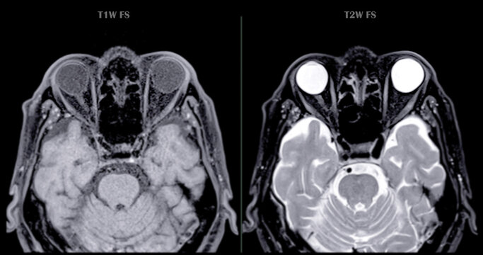 Image of MRI orbit scan with gadolinium contrast in normal case displays comprehensive views for eye disease diagnosis.