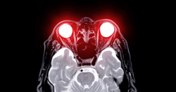 Image of MRI orbit scan with gadolinium contrast in normal case displays comprehensive views for eye disease diagnosis.