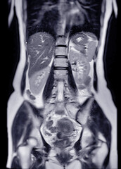 MRI abdomen coronal views are particularly useful for assessing liver, kidneys, and other abdominal organs with precision.