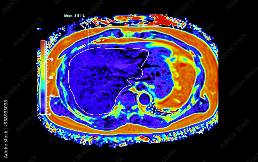 Poster an mri pet scan of the abdomen in axial view provides a detailed cross-sectional image, helping to d