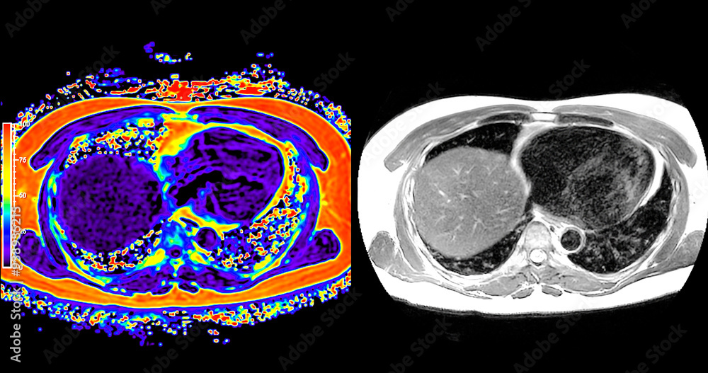 Poster an mri pet scan of the abdomen in axial view provides a detailed cross-sectional image, helping to d