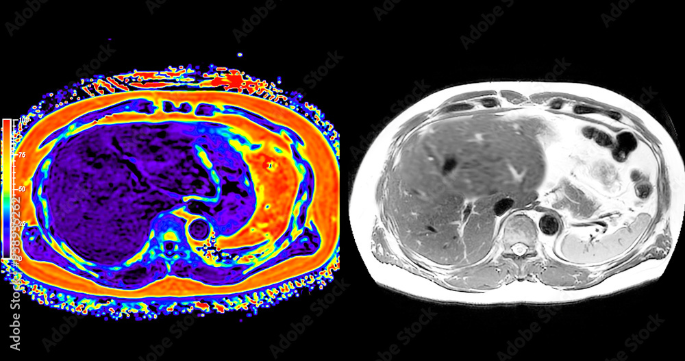 Poster an mri pet scan of the abdomen in axial view provides a detailed cross-sectional image, helping to d
