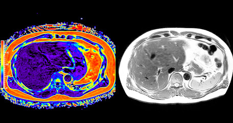 An MRI PET scan of the abdomen in axial view provides a detailed cross-sectional image, helping to detect abnormalities with high precision.