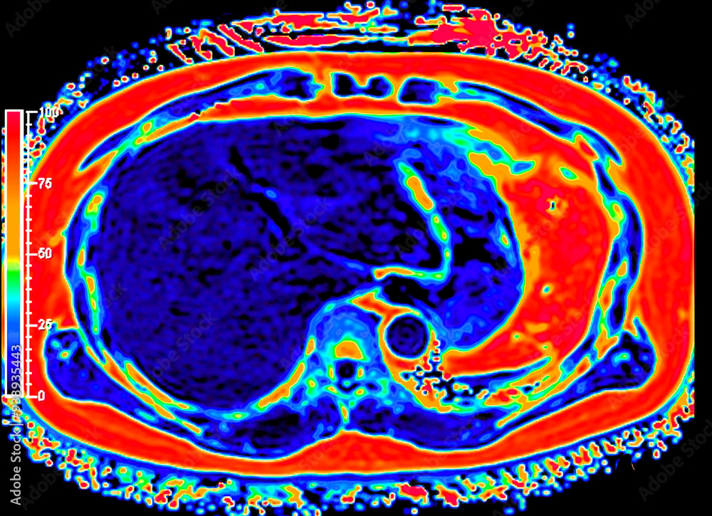 Poster an mri pet scan of the abdomen in axial view provides a detailed cross-sectional image, helping to d