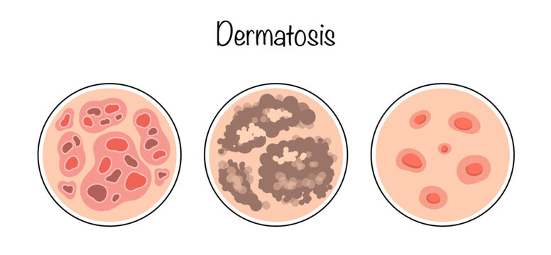 Dermatosis