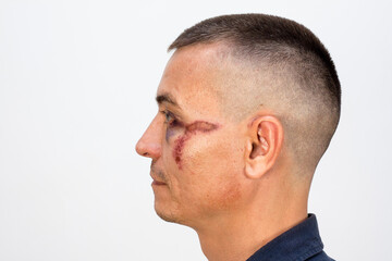 Obraz premium Male mixed martial arts fighter without rules with eye injury.