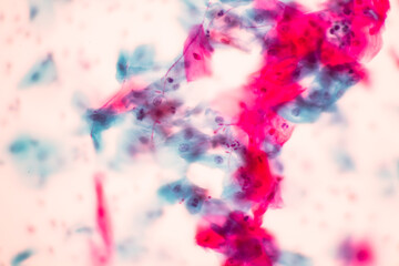 View in microscopic of Candidiasis, fungus infection (Yeast and Pseudohyphae form) in pap smear...