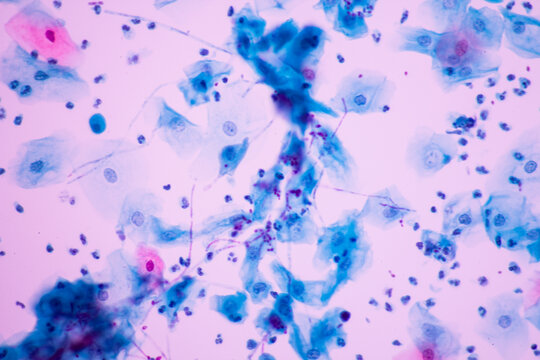 View in microscopic of Candidiasis, fungus infection (Yeast and Pseudohyphae form) in pap smear slide cytology and diagnostic by pathologist.Gynecology report and diagnosis.Sexually transmitted infect
