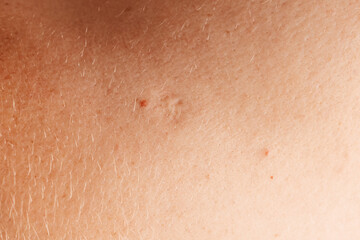 Fototapeta premium Small scar on human skin.