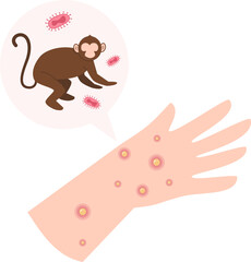 Monkeypox virus Illustration 