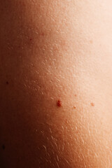 A close-up of skin with small moles, perfect for dermatology, skincare, or medical-themed projects.