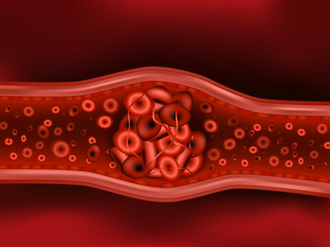 Embolus. Illustration depicting embolism from detached thrombus. Blood clots or thrombus with coagulated erythrocytes.