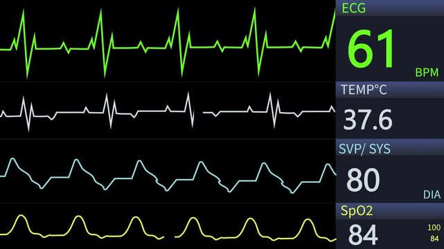 Animated video of a patient monitor screen displaying vital sign values, including heart rate, blood pressure, oxygen saturation, and respiratory rate. Healthcare, medical monitoring technology. 4k