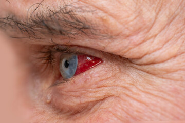 Bloodshot male eye in close-up shot, revealing raw detail burst vessel and underlying stress,...