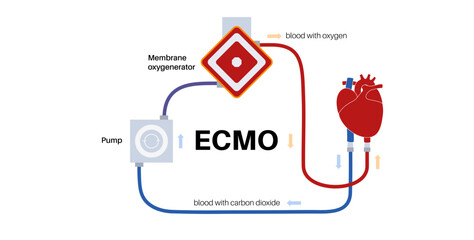 Extracorporeal membrane oxygenation