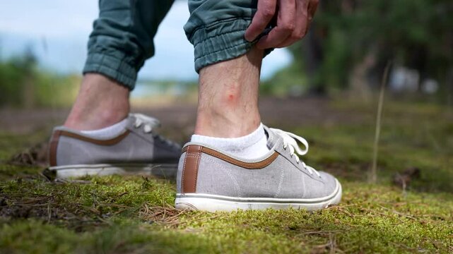 Unrecognizable man hands scratching itchy ankles on nature hike. Exposed skin suffers bites from gnats, mosquitoes, flies. Allergic reactions follow bites, improper clothing leaves skin vulnerable
