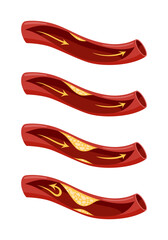Obraz premium Atherosclerosis stage icon set. Anatomy of heart attack. Arteriosclerotic vascular disease or ASVD. Atherosclerotic plaque in coronary artery. Vector illustration on white background