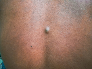 Fototapeta premium small bumps on men's backs with dry skin and large pores. unhealthy skin. bruises on the back