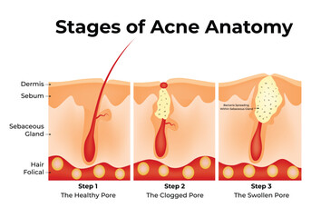 Stages of Acne Anatomy Science Design Vector Illustration Diagram