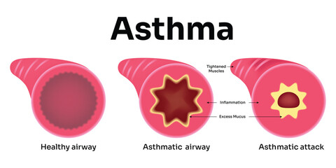 Asthma Science Design Vector Illustration Diagram