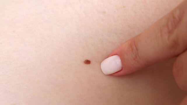 Female skin with birthmark (mole or nevus) touching by finger during medical examining