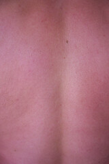 sunburn on the skin of a man. swollen skin from blisters on the boy's shoulder. red skin he has an overabundance of sun. sunburn at a dangerous hour