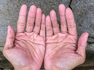Pruney fingers or wrinkles fingers skin shriveled after prolonged exposure to water. Stratum...