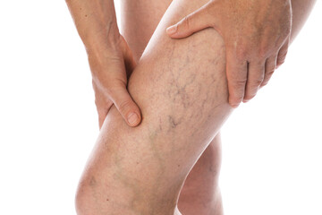 Woman suffering from varicose veins on white background, closeup