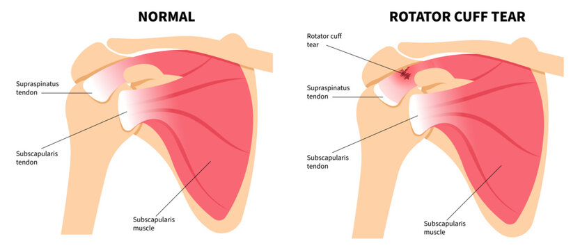 Shoulder muscle with Degenerative rotator cuff disease or sport injury