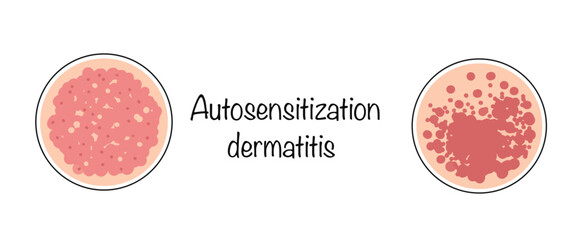 Autosensitization dermatitis