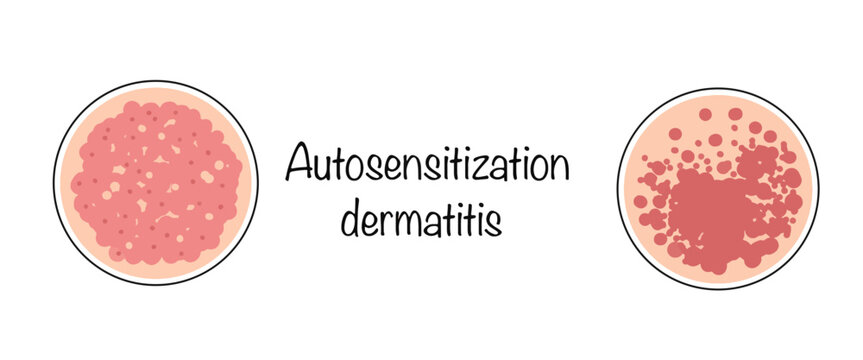 Autosensitization dermatitis