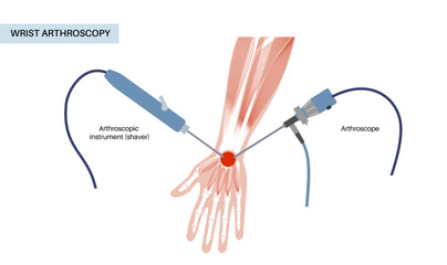 Wrist arthroscopy surgery